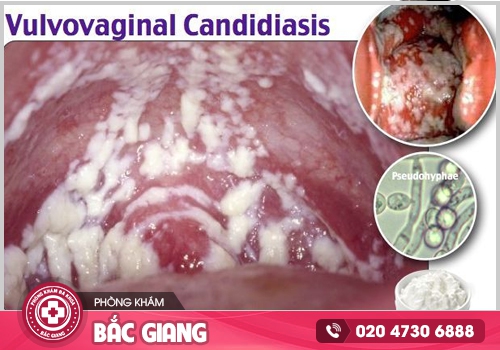 Cách trị nấm Candida tại nhà có nên hay không?