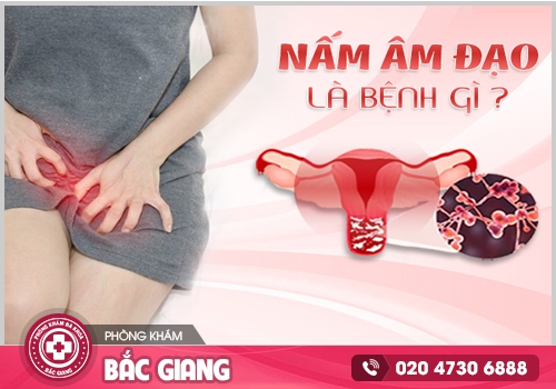 nấm âm đạo