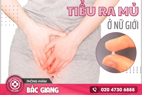 Tiểu ra mủ ở nữ giới là dấu hiệu cảnh báo bệnh gì?