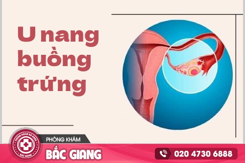 Hình ảnh u nang buồng trứng ở nữ giới