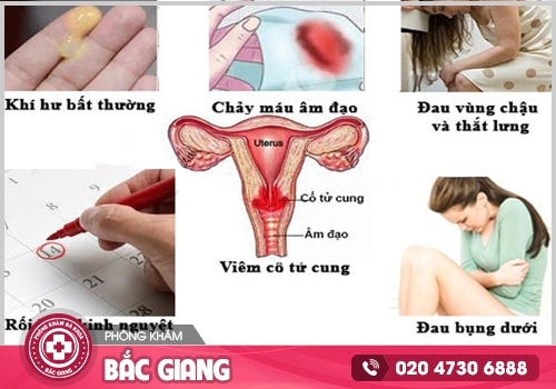 Tìm hiểu về viêm cổ tử cung trước khi bệnh ảnh hưởng tới sức khoẻ