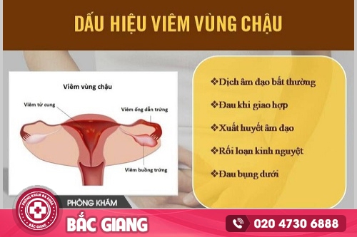 Thông tin về bệnh viêm vùng chậu mà chị em cần lưu ý